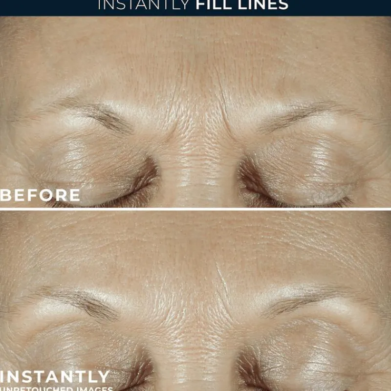 Best RoC Derm Correxion Fill + Treat Serum 15 ML